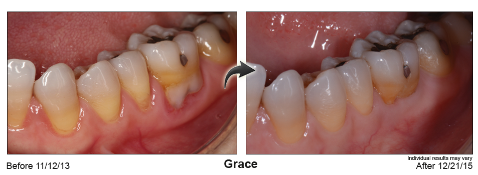 fix gum recession Wilmington Delaware