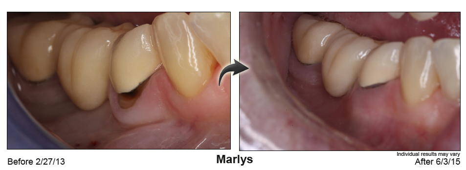 fix receding gums Wilmington Delaware