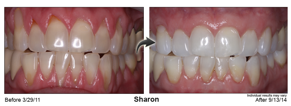 gum recession treatment Wilmington Delaware